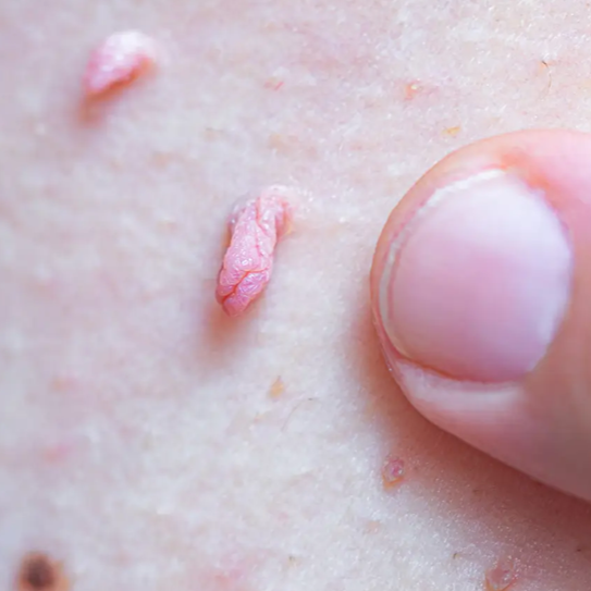 Removedor de Verrugas sin Dolor