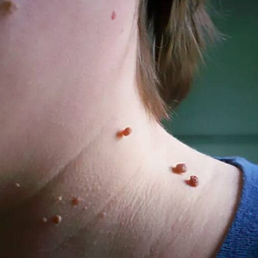 Removedor de Verrugas sin Dolor